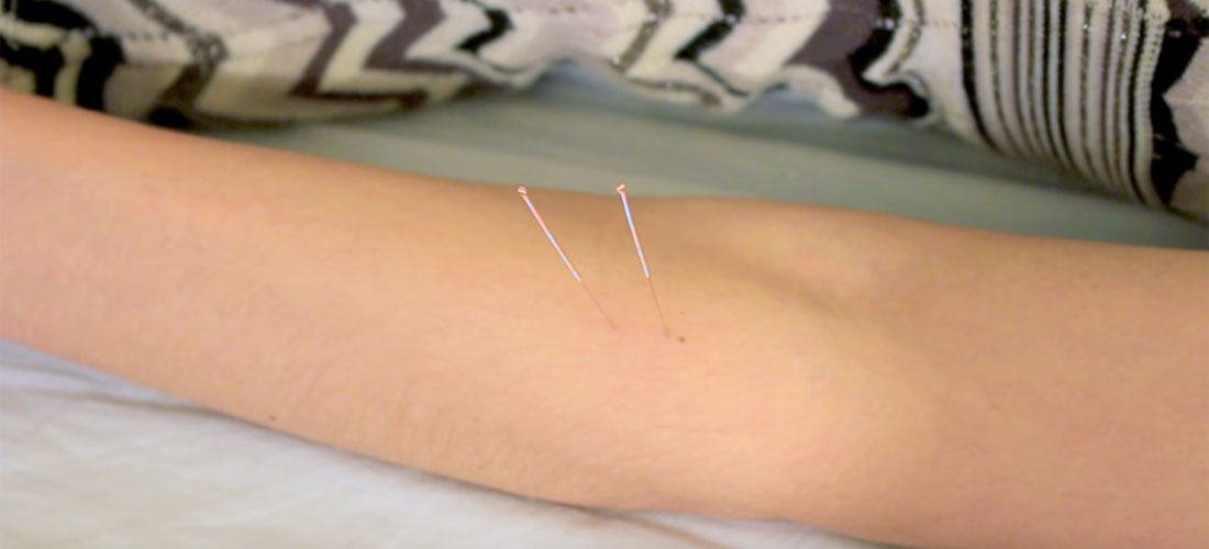 Qu’est-ce que l’acupuncture ?